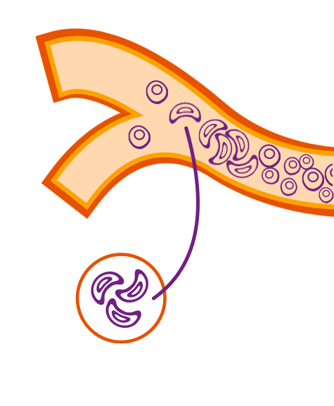 Crescent-Sickle-Diagram.jpg Crescent-Sickle-Diagram.jpg